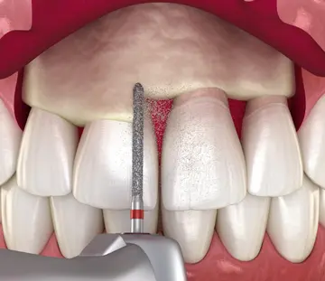 جراحی-اصلاح-خط-لبخند