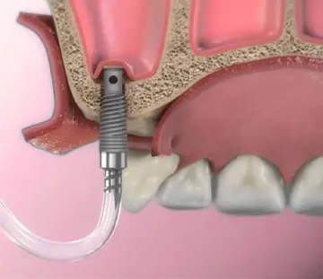 جراحی-سینوس-لیفت