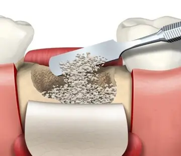 جراحی-پیوند-استخوان