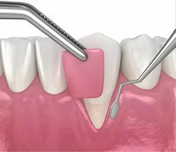 جراحی-پیوند-لثه