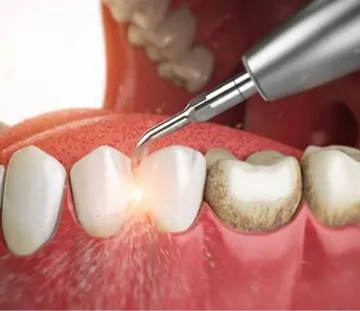 جرم-گیری-و-درمان-بیماری-های-لثه